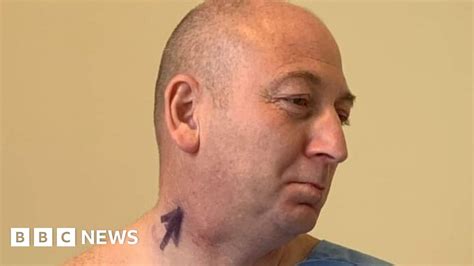 Cancer: Neck lump patient in robot surgery first - BBC News