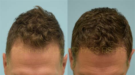 Dallas Finasteride and Minoxidil Before and After Photos - Plano ...