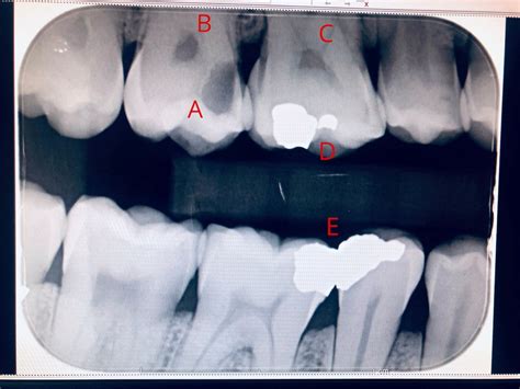 Eric Davis Dental - What Do Cavities Look Like?