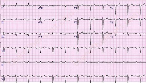 First Degree AV Block ECG 5 | LearntheHeart.com