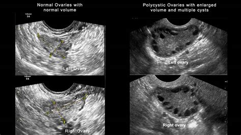 Polycystic Ovary Syndrome (PCOS): Cause, Symptoms & Treatment