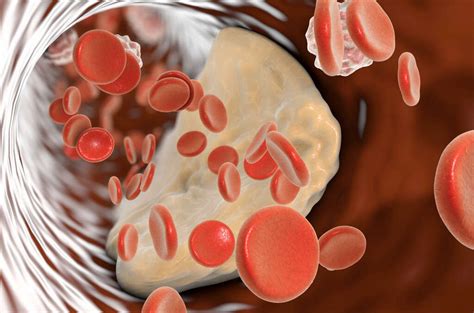 Atheroma: What Is an Atheroma?