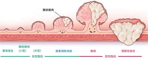 全面了解大腸癌成因、症狀、存活率及預防方法！ | Bowtie