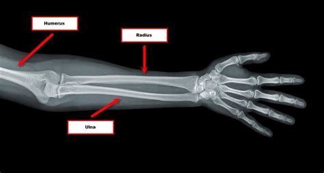 Radius And Ulna And Humerus