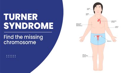 Turner’s syndrome – Types, Symptoms, Risk factors, and Treatments