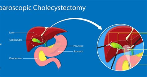 Real Psychiatry: The Laparoscopic Cholecystectomy