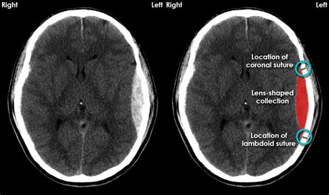 types of brain hemorrhages | Subdural hematoma, Hemorrhage nursing ...