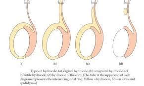 Hydrocele Treatment: Hydrocele Symptoms, Causes, Repair And Surgery