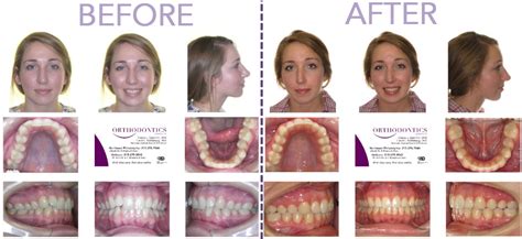 Invisalign Before and After Invisalign Reviews Philadelphia ...