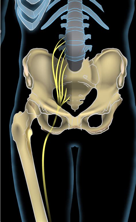 Sciatica - Wikipedia