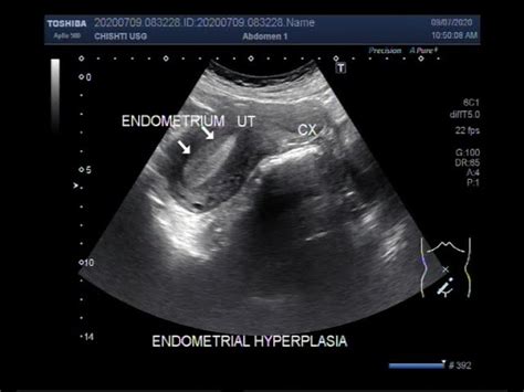 Cystic Endometrial Hyperplasia Ultrasound