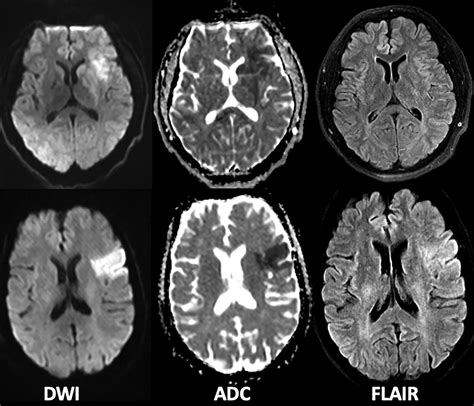 Ischemic Stroke Mri