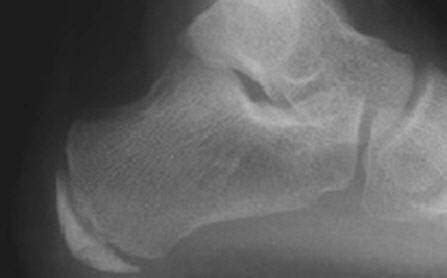 Sever's Disease - Pediatrics - Orthobullets