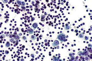 Mesothelial cytopathology - Libre Pathology