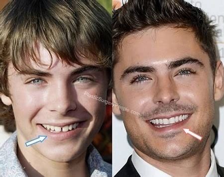 Zac Efron’s Plastic Surgeries and Teeth Modification – Before and After ...