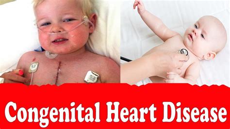 Congenital Heart Defects Symptoms