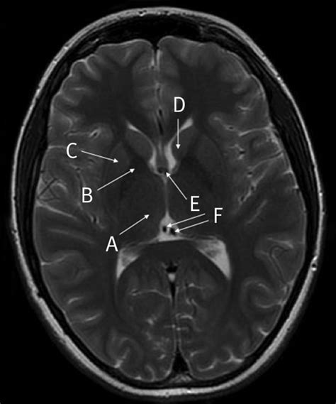 Mri Brain Anatomy