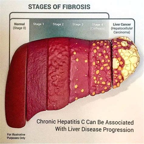 Liver Injury and Obesity - DSSurgery