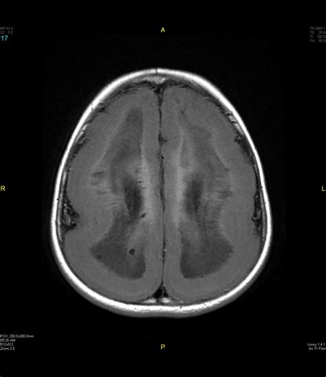 Lissencephaly | Image | Radiopaedia.org