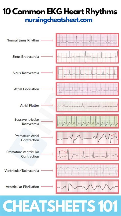 10 Common EKG Heart Rhythms 2022 | Ekg interpretation, Ekg, Nurse study ...