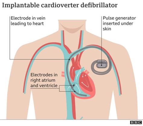 Heart starting device: Christian Eriksen go get 'ICD - implantable ...