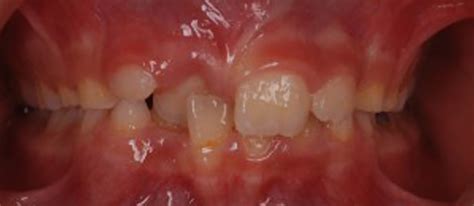 Posterior crossbite orthodontic - Dr Jamilian