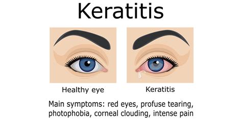 Keratitis | AOA