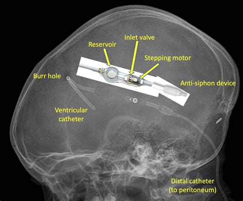 Cerebrospinal shunts - Questions and Answers in MRI