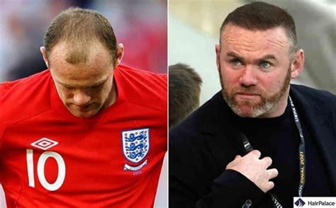 Wayne Rooney Hair Transplant | Success or Failure?