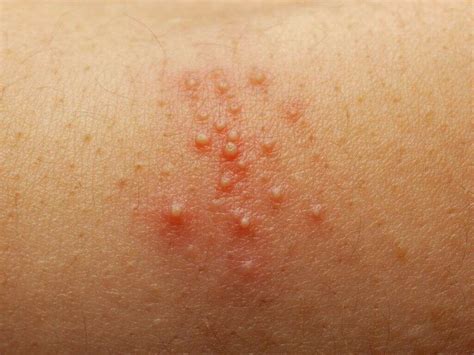 Staph Infection: 10 Staph Infection Symptoms