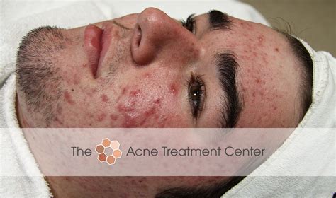 Before/After Patient Photos | Hyperpigmentation, Inflamed Acne | The ...