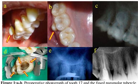 Figure 1 from Endodontic Management of a Rare Anamoly of Paramolar ...