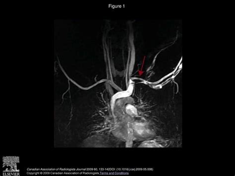 MRA: Current Applications in Body Vascular Imaging - ppt download