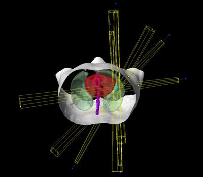 Sbrt Lung - All About Radiation