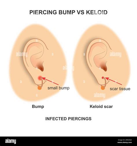 Ear piercing bump vs keloid Stock Photo - Alamy