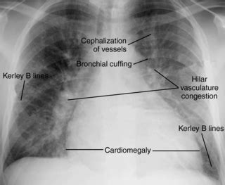 Kerley B Lines On Chest X Ray