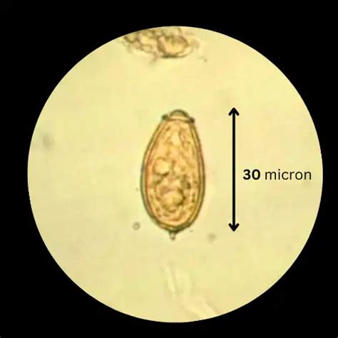 Clonorchis sinensis Infection2024: Symptoms, Diagnosis, and Treatment ...