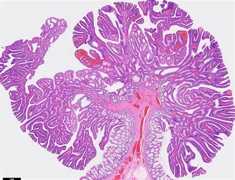 Tubular Adenoma Histology