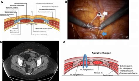 Anatomy below the arcuate line and location of the spiral technique ...