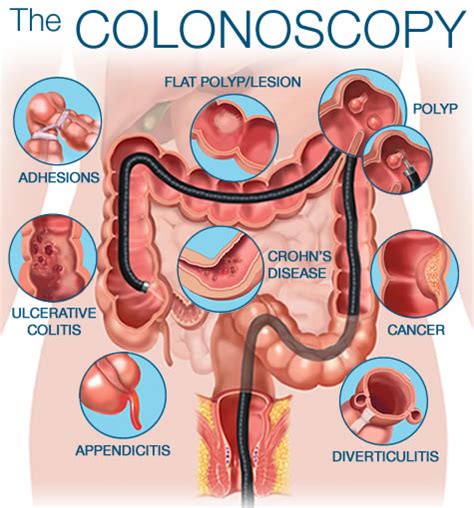 Consideration of colonoscopy ~ Revolution PharmD