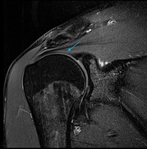 mri-shoulder-normal-supraspinatus-tendon-6 - MRI at Melbourne Radiology ...