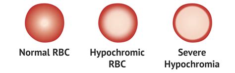 Hypochromia | Test Findings - MedSchool