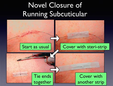 Subcuticular Suturing Pearls – Closing the Gap