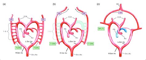 Embryologic development of a right aortic arch and single bilateral ...