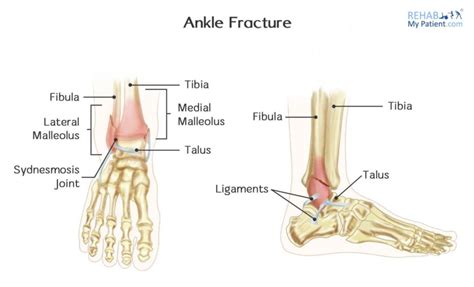 Ankle Sprain vs. Fracture Treatment | Cawley Physical Therapy