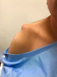 AC Joint Separation Recovery Time, Shoulder Separation | Dr. Steven ...