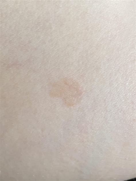 Discoloured patch of skin : DermatologyQuestions