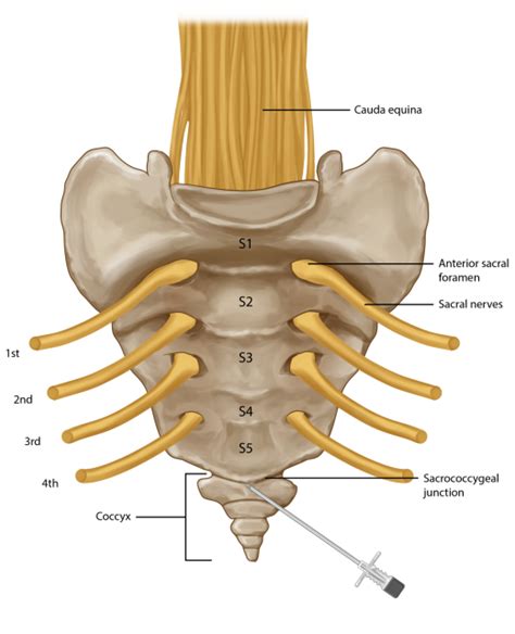 Coccyx Injection | Coccyx Pain Treatment | Pain Spa, Bristol, UK