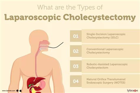 Laparoscopic Cholecystectomy: Treatment, Procedure, Cost, Recovery ...