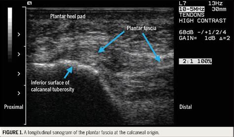 Hyperemia in plantar fasciitis determined by power Doppler ultrasound ...